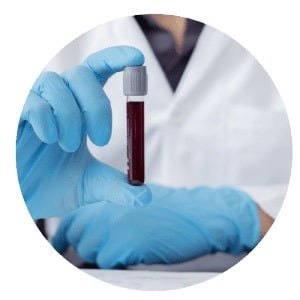 Hashimoto-Diagnostik-Schilddruesenunterfunktion